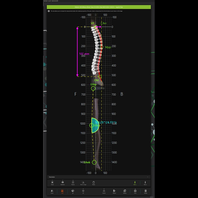 Система трёхмерного сканирования позвоночника Spine3D